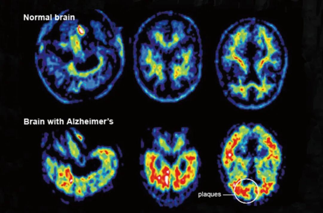 3.PET扫描的健康大脑和阿尔茨海默病患者大脑成像.jpg