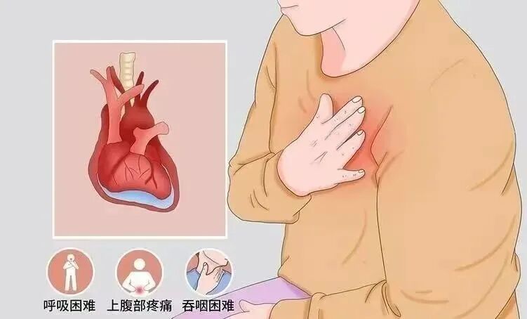 穿刺包怎么使用超声引导下心包积液穿刺抽吸与置管引流_https://www.jmylbn.com_新闻资讯_第7张