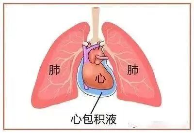 穿刺包怎么使用超声引导下心包积液穿刺抽吸与置管引流_https://www.jmylbn.com_新闻资讯_第6张