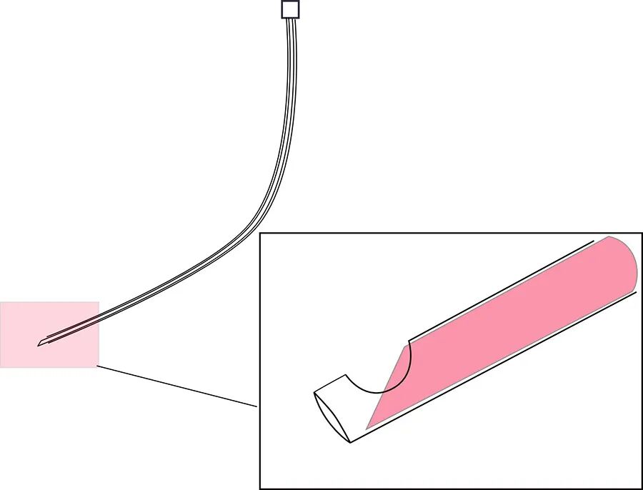 体疗器械分为什么使用脊髓针技术取出分离器械的临床疗效：30年临床经验的回顾性研究_https://www.jmylbn.com_新闻资讯_第2张
