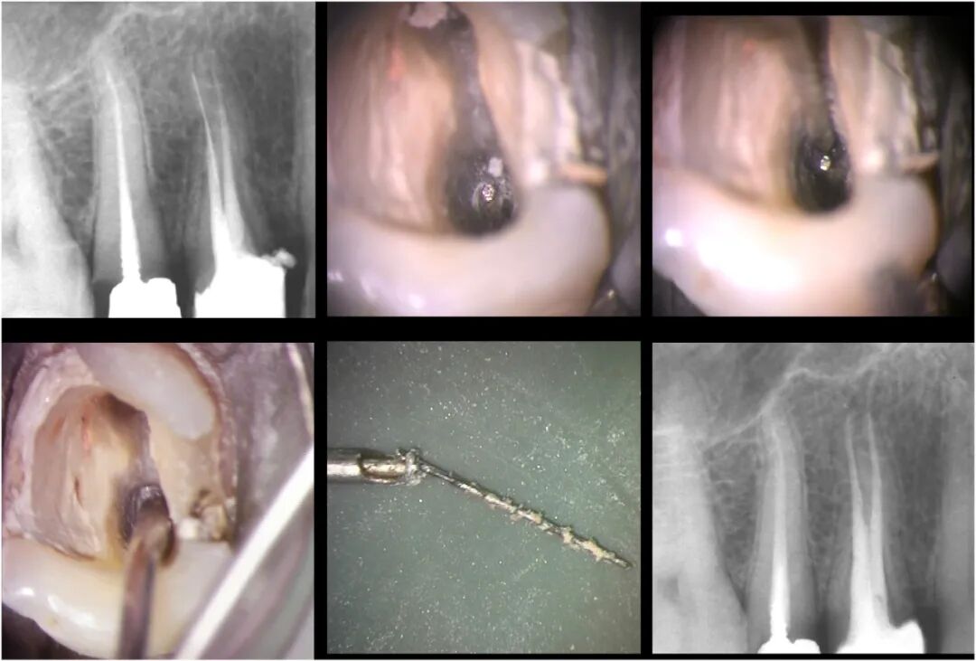 体疗器械分为什么使用脊髓针技术取出分离器械的临床疗效：30年临床经验的回顾性研究_https://www.jmylbn.com_新闻资讯_第9张