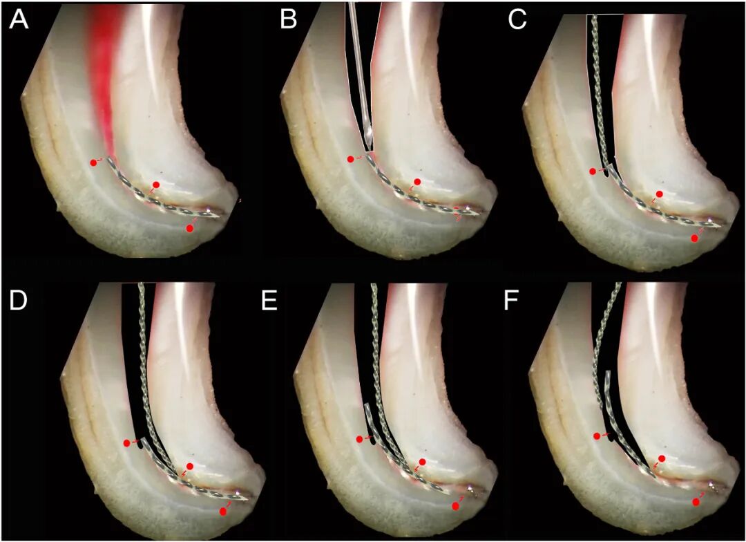 体疗器械分为什么使用脊髓针技术取出分离器械的临床疗效：30年临床经验的回顾性研究_https://www.jmylbn.com_新闻资讯_第7张