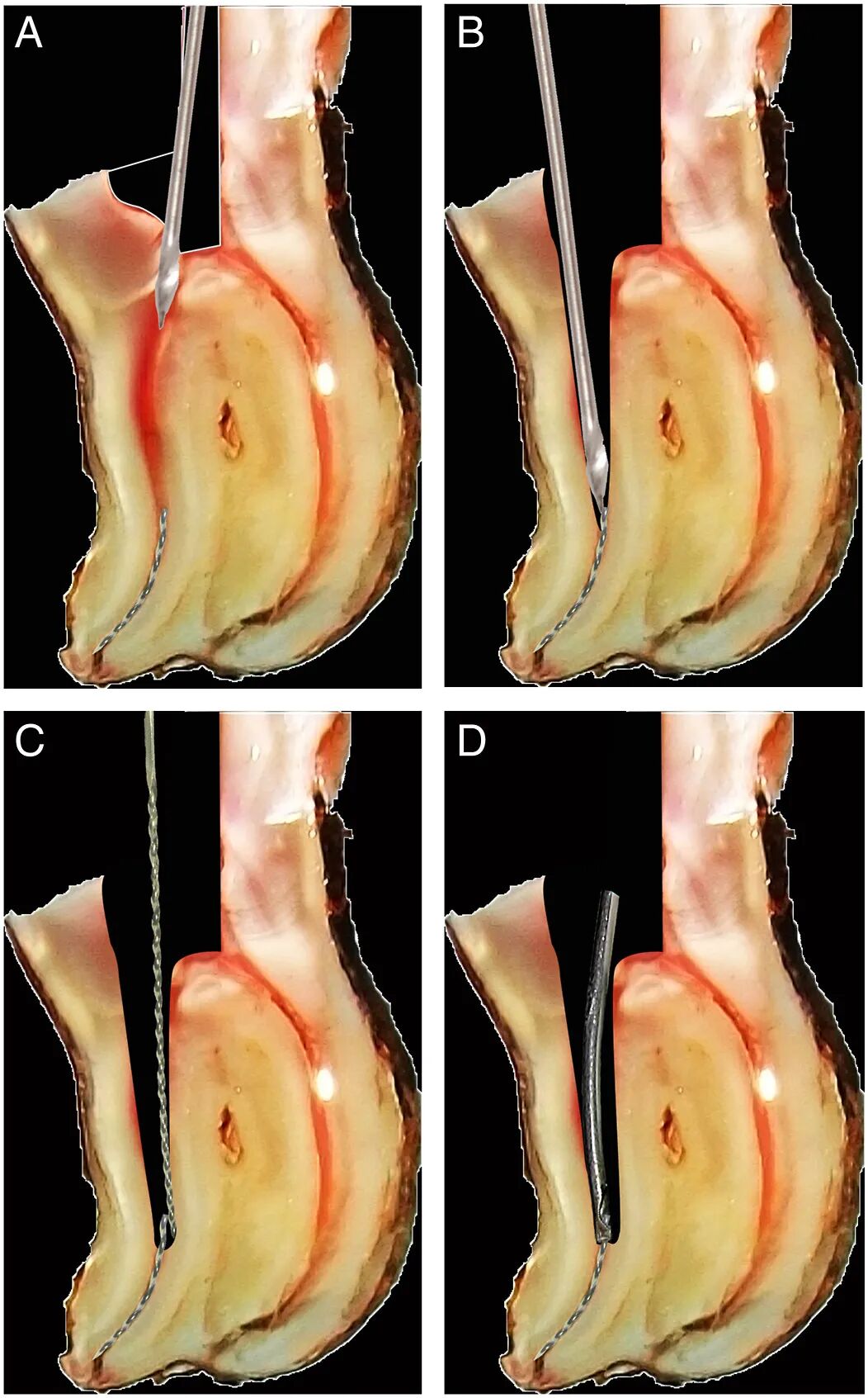 体疗器械分为什么使用脊髓针技术取出分离器械的临床疗效：30年临床经验的回顾性研究_https://www.jmylbn.com_新闻资讯_第4张