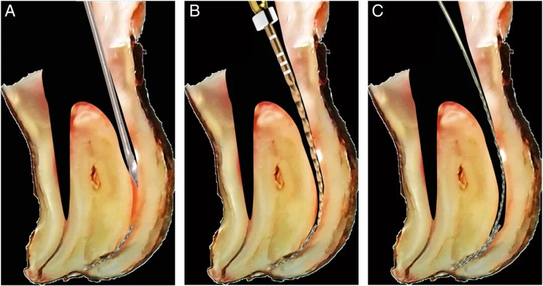 体疗器械分为什么使用脊髓针技术取出分离器械的临床疗效：30年临床经验的回顾性研究_https://www.jmylbn.com_新闻资讯_第6张