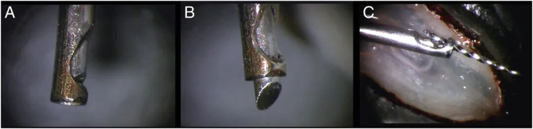 体疗器械分为什么使用脊髓针技术取出分离器械的临床疗效：30年临床经验的回顾性研究_https://www.jmylbn.com_新闻资讯_第5张