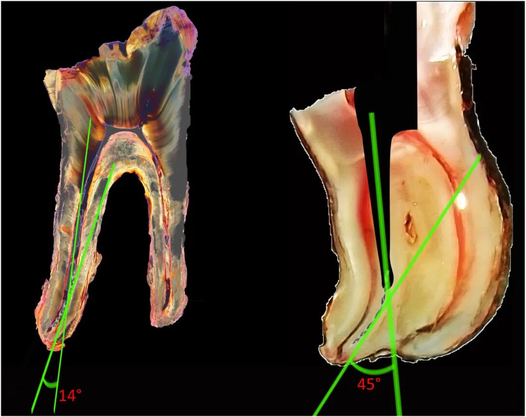 体疗器械分为什么使用脊髓针技术取出分离器械的临床疗效：30年临床经验的回顾性研究_https://www.jmylbn.com_新闻资讯_第3张