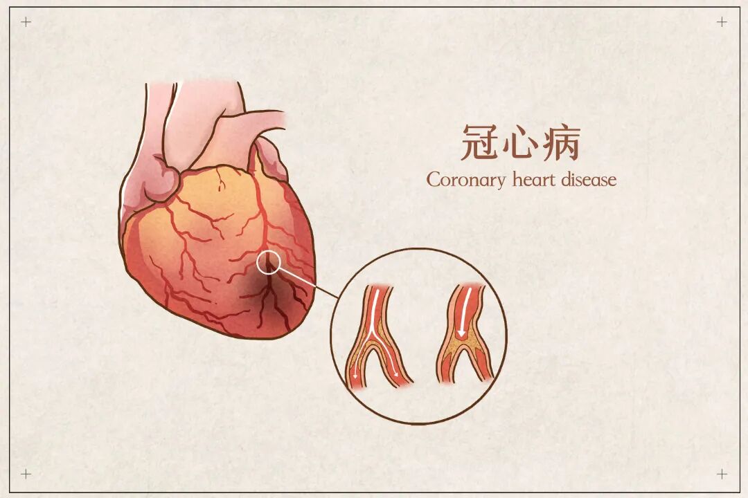 摄图网_401789046_冠心病医疗插画示意图_(企业商用).jpg