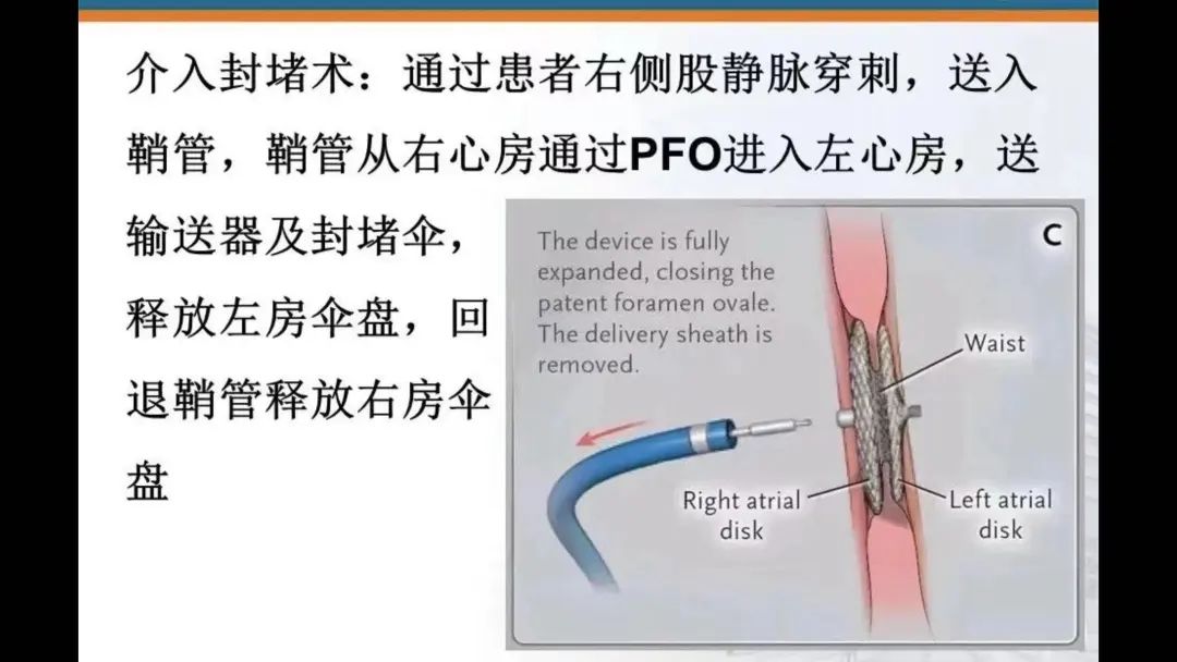 卵圆孔未闭手术图片图片