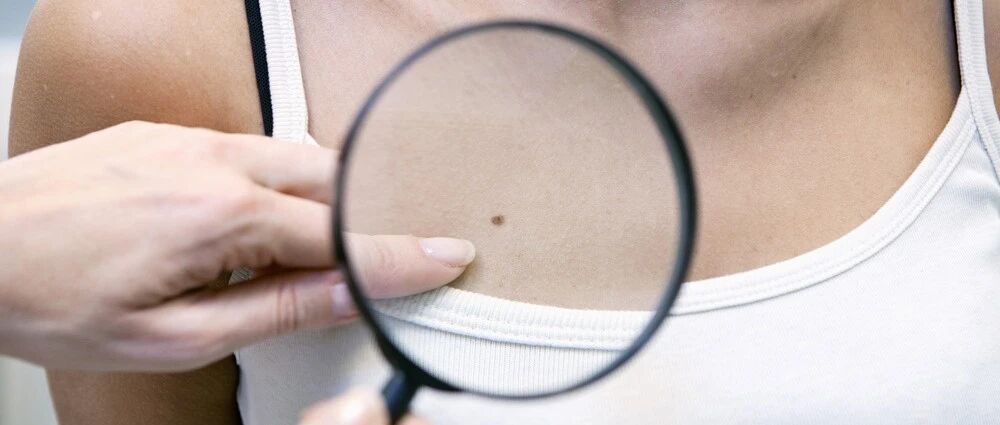 身体上的黑痣，会变成黑色素瘤吗？