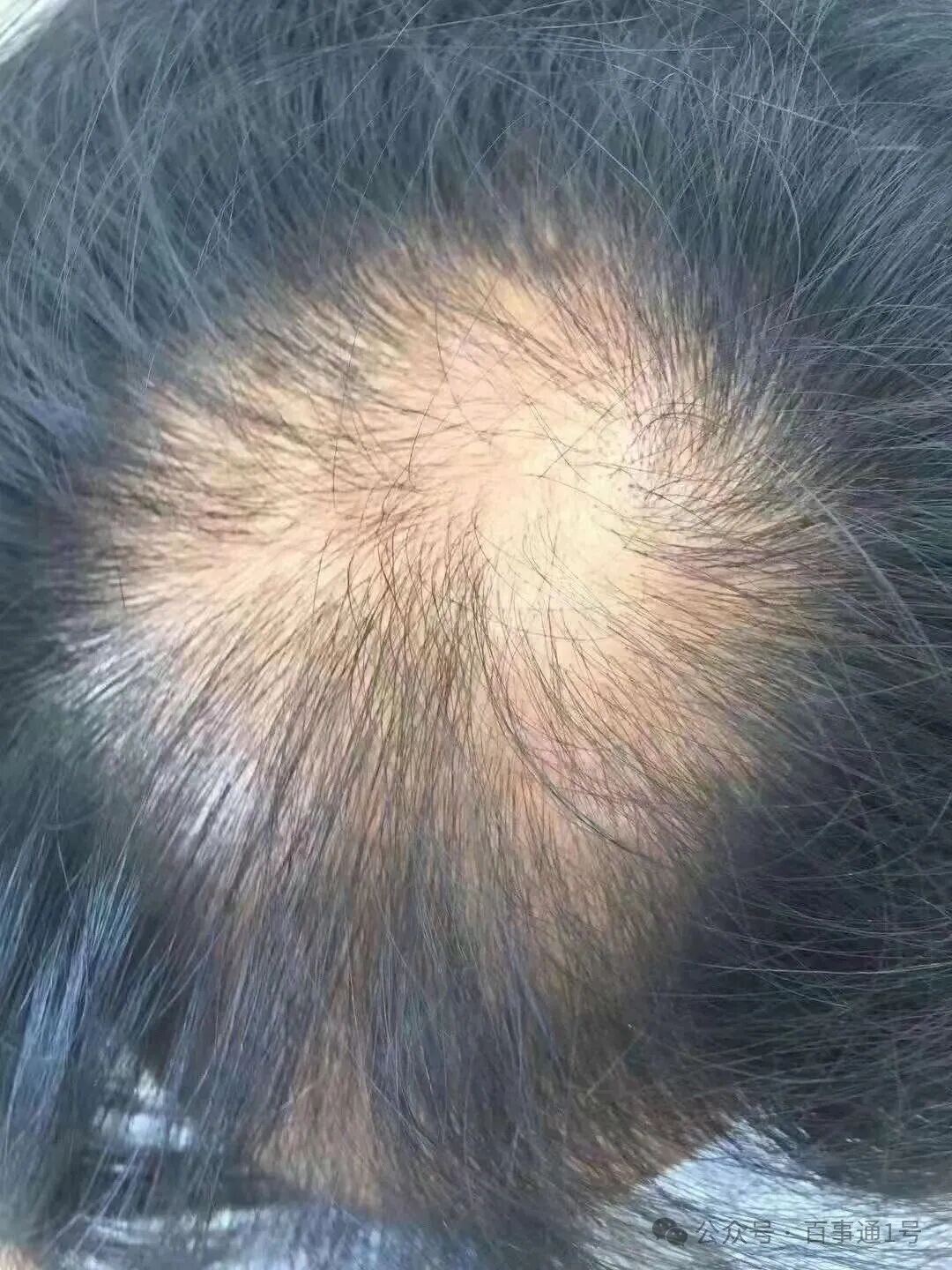 白发、脱发去医院挂哪个科？头皮养护，必须了解的头皮知识