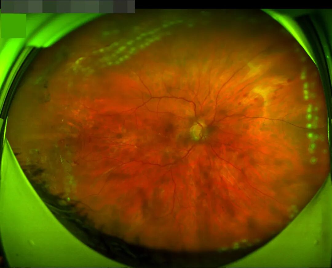 意大利眼科怎么样从意大利飞到杭州，眼睛突然看不见了……_https://www.jmylbn.com_新闻资讯_第16张