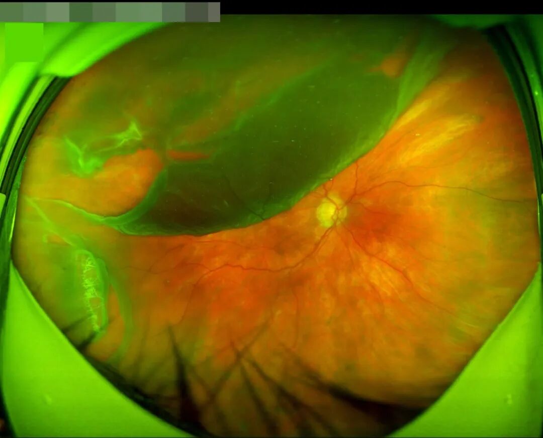 意大利眼科怎么样从意大利飞到杭州，眼睛突然看不见了……_https://www.jmylbn.com_新闻资讯_第4张