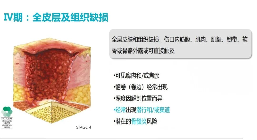 性敷料是什么压力性损伤的临床分期及措施_https://www.jmylbn.com_新闻资讯_第10张