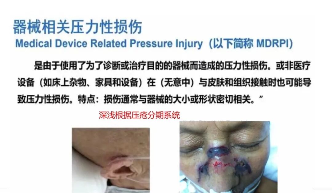 性敷料是什么压力性损伤的临床分期及措施_https://www.jmylbn.com_新闻资讯_第13张