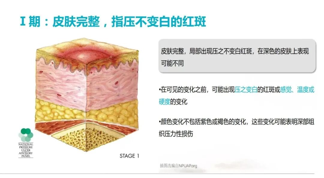 性敷料是什么压力性损伤的临床分期及措施_https://www.jmylbn.com_新闻资讯_第7张