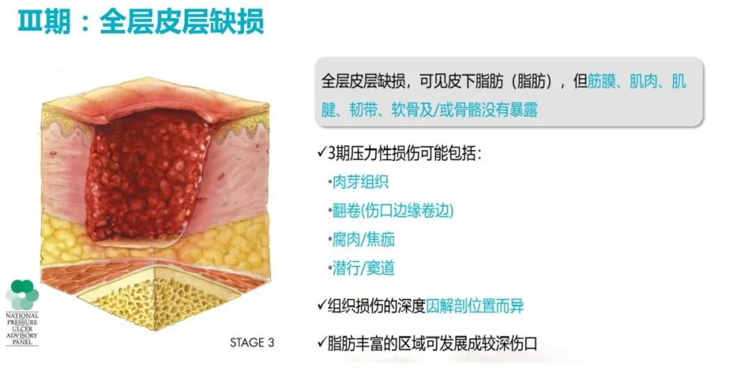 性敷料是什么压力性损伤的临床分期及措施_https://www.jmylbn.com_新闻资讯_第9张