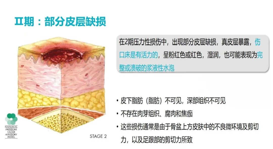 性敷料是什么压力性损伤的临床分期及措施_https://www.jmylbn.com_新闻资讯_第8张
