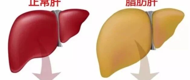 得了脂肪肝，除了减肥，还应做什么？（转自河北省红十字基金会医院）