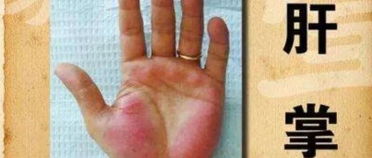 如手上出现肝掌，要注意可能是肝脏出现了病变！
