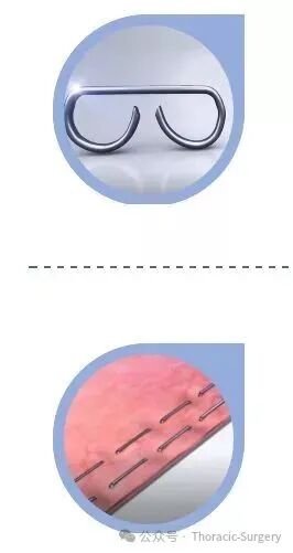 为什么用吻合器缝合【医学随笔】第3期-孙锋教授-外科兵器谱——吻合器的前世今生（上）_https://www.jmylbn.com_新闻资讯_第6张