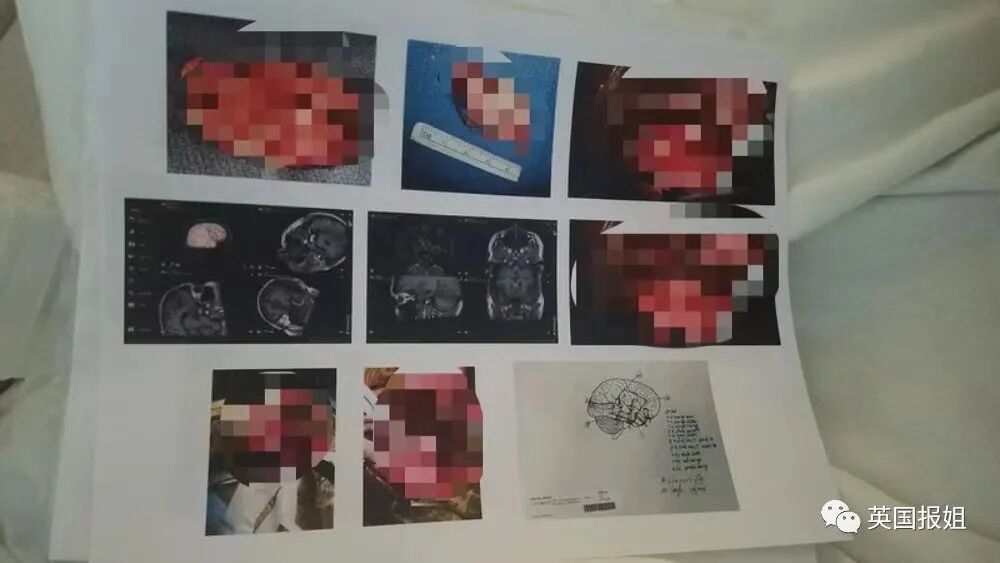 因为害怕死，美国小哥动手术切掉部分大脑：彻底消除恐惧感（组图） - 6