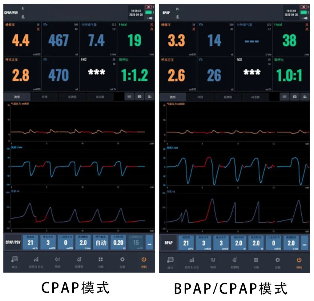 bipap是什么意思科普指南丨呼吸机BPAP模式在临床中的应用_https://www.jmylbn.com_新闻资讯_第9张