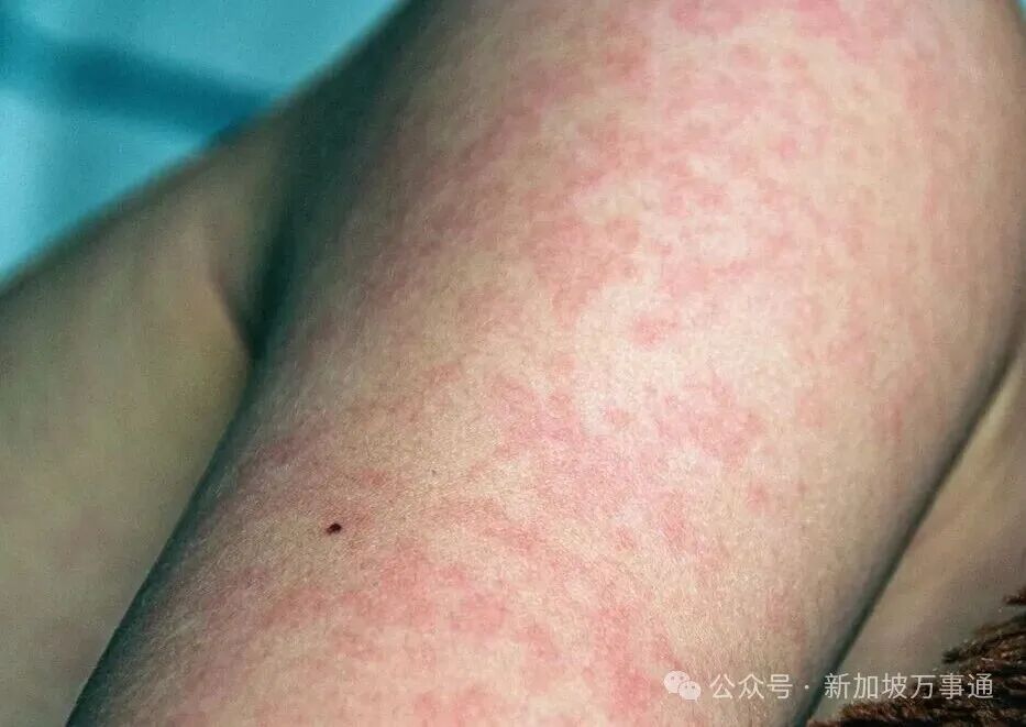 麻疹醫院群聚》麻疹有什麼症狀？潛伏期、傳染途徑、治療方法一次看|Uho優活健康網