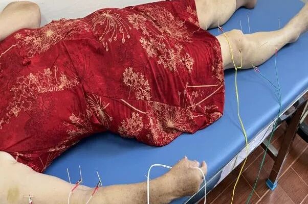 电针理疗是什么南安乡卫生院中医康复理疗门诊开诊啦！_https://www.jmylbn.com_新闻资讯_第5张