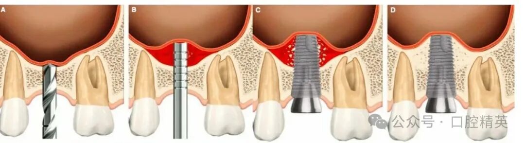 上颌窦底提升专家共识