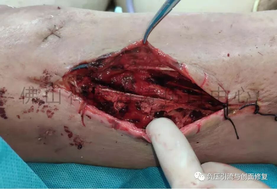 经验分享急性坏死性筋膜炎的诊断与处理