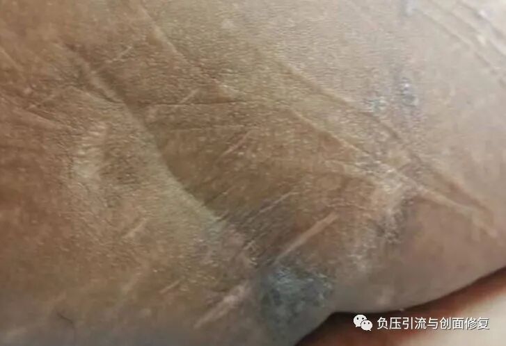 坐骨结节四期压疮外科手术为首选的治疗方案