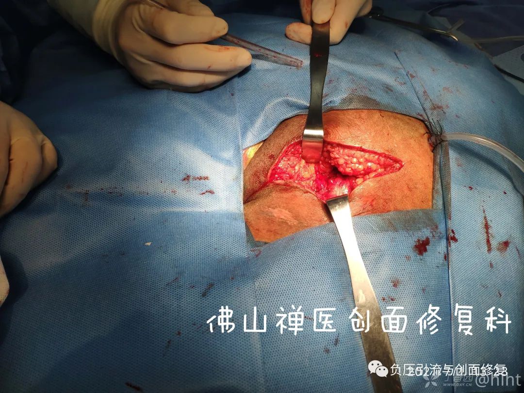 坐骨结节四期压疮外科手术为首选的治疗方案
