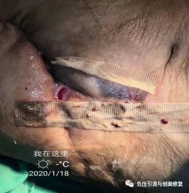 伤口负压治疗怎么收费致敬一名基层伤口专科护士，孤勇者里面的英雄，用纱布负压治愈胆漏_https://www.jmylbn.com_新闻资讯_第2张