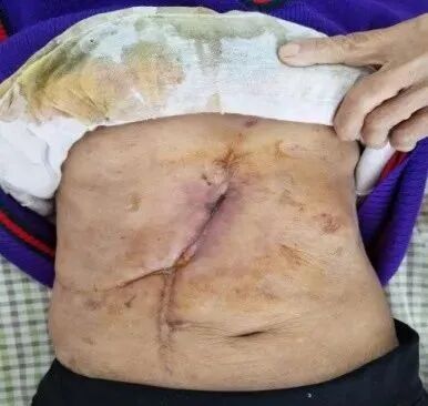 伤口负压治疗怎么收费致敬一名基层伤口专科护士，孤勇者里面的英雄，用纱布负压治愈胆漏_https://www.jmylbn.com_新闻资讯_第1张