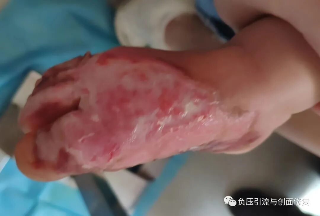 手术防粘连液怎么用儿童烫伤，推荐一款可以防粘连、抗菌、吸渗液的敷料_https://www.jmylbn.com_新闻资讯_第2张