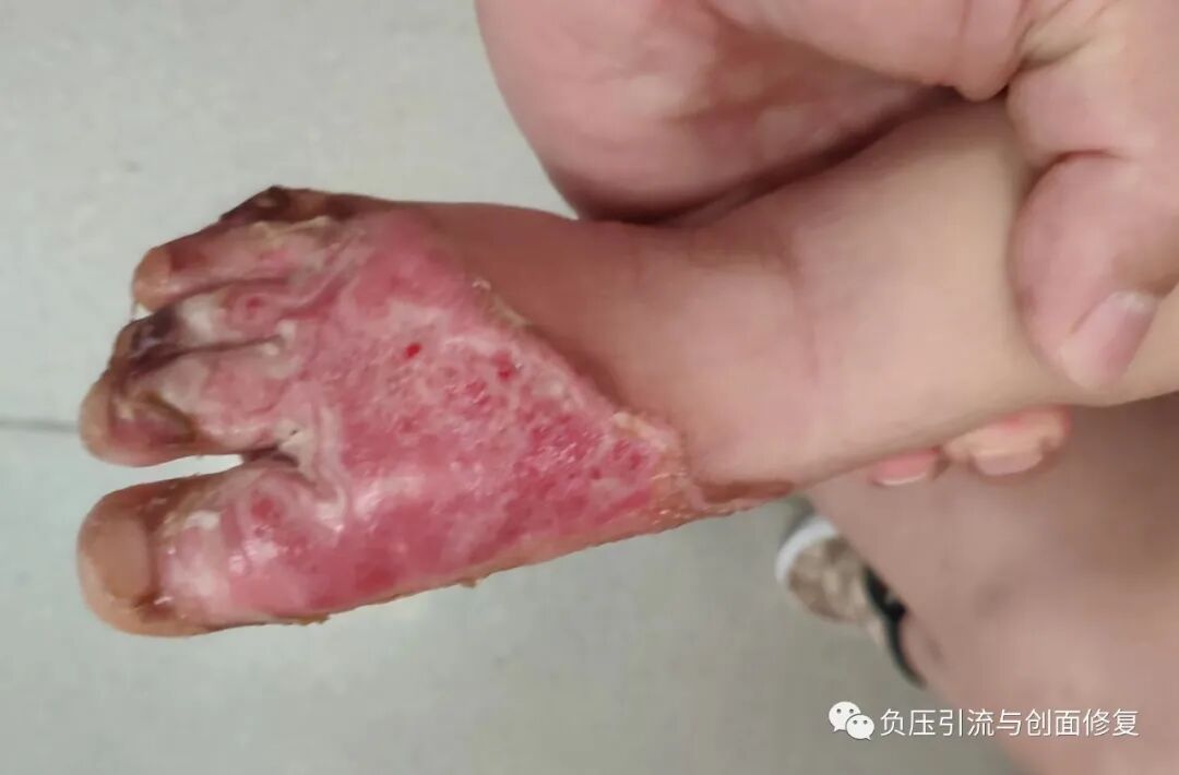 手术防粘连液怎么用儿童烫伤，推荐一款可以防粘连、抗菌、吸渗液的敷料_https://www.jmylbn.com_新闻资讯_第3张