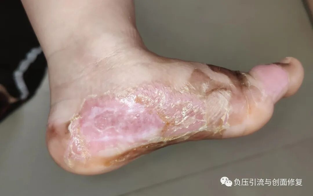 手术防粘连液怎么用儿童烫伤，推荐一款可以防粘连、抗菌、吸渗液的敷料_https://www.jmylbn.com_新闻资讯_第5张