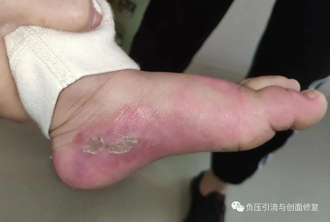 手术防粘连液怎么用儿童烫伤，推荐一款可以防粘连、抗菌、吸渗液的敷料_https://www.jmylbn.com_新闻资讯_第6张