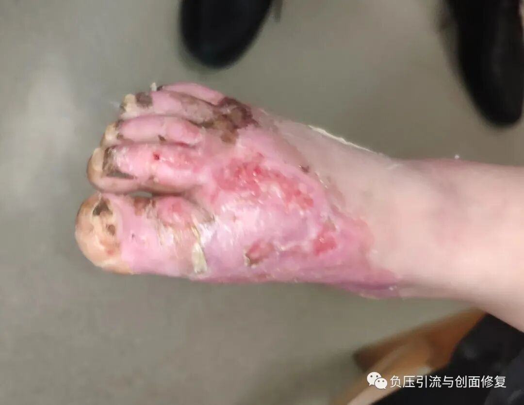 手术防粘连液怎么用儿童烫伤，推荐一款可以防粘连、抗菌、吸渗液的敷料_https://www.jmylbn.com_新闻资讯_第4张