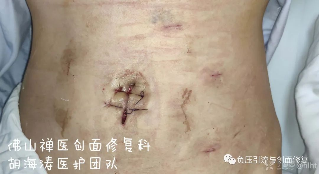 病例肚脐潮湿发臭30年肿痛流脓1月诊断为脐尿管瘘