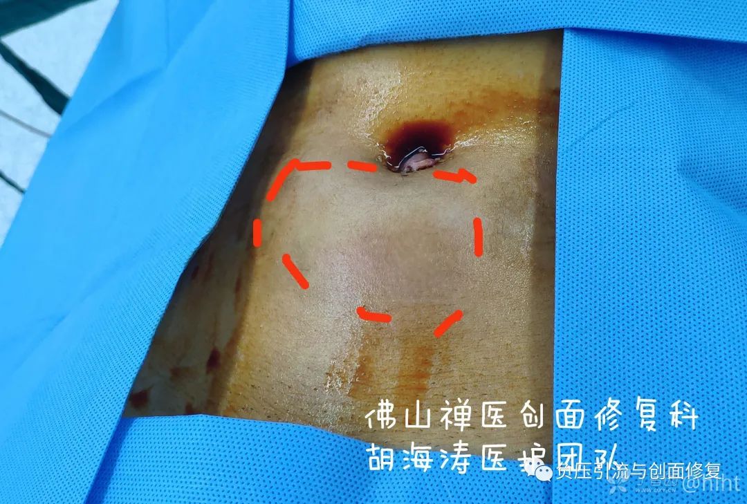 病例肚脐潮湿发臭30年肿痛流脓1月诊断为脐尿管瘘