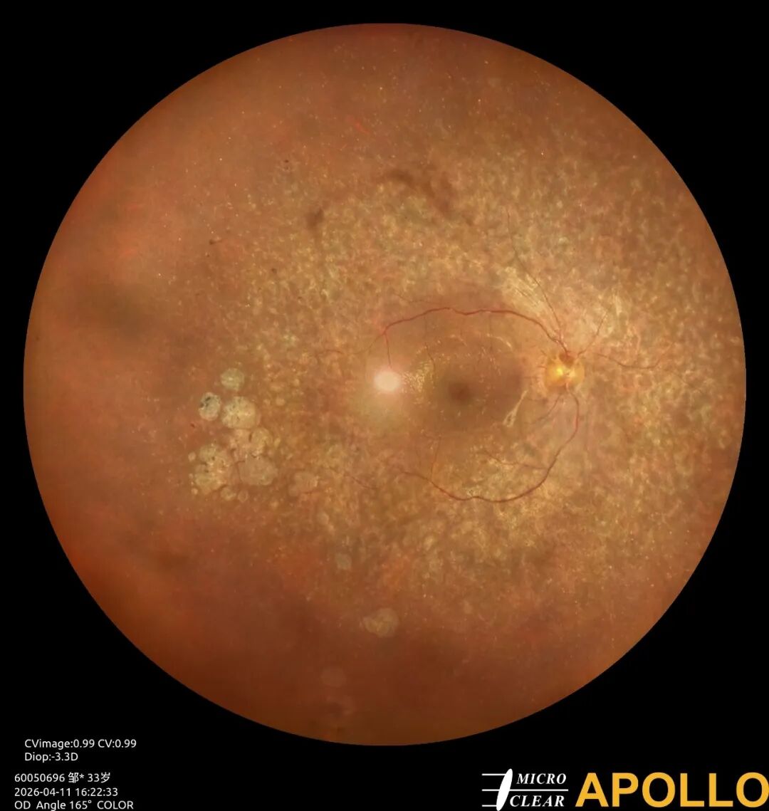 彩色眼底照相查什么眼底“侦察兵”上线！平湖一院眼科新增广角眼底激光相机_https://www.jmylbn.com_新闻资讯_第17张