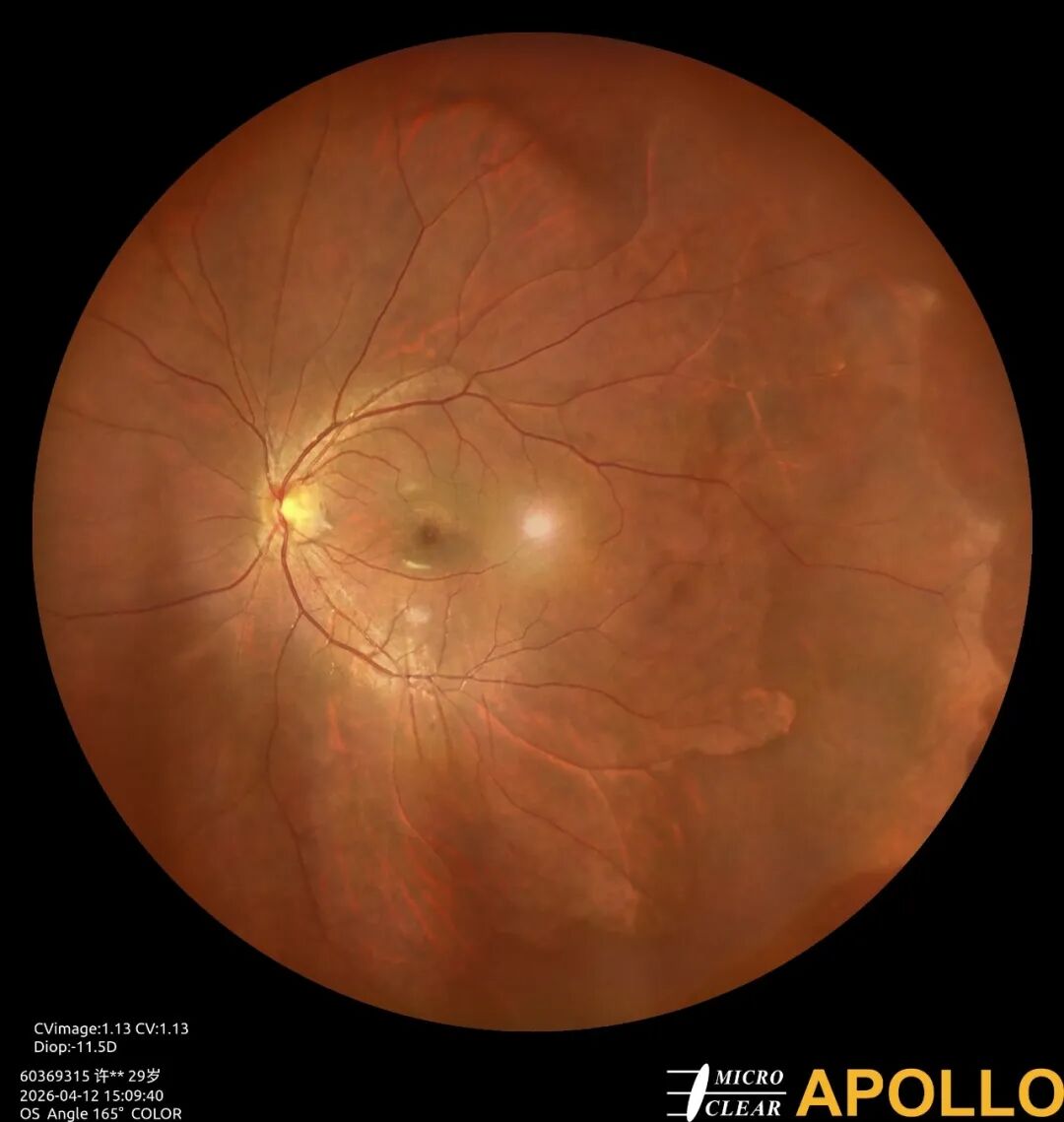 彩色眼底照相查什么眼底“侦察兵”上线！平湖一院眼科新增广角眼底激光相机_https://www.jmylbn.com_新闻资讯_第19张