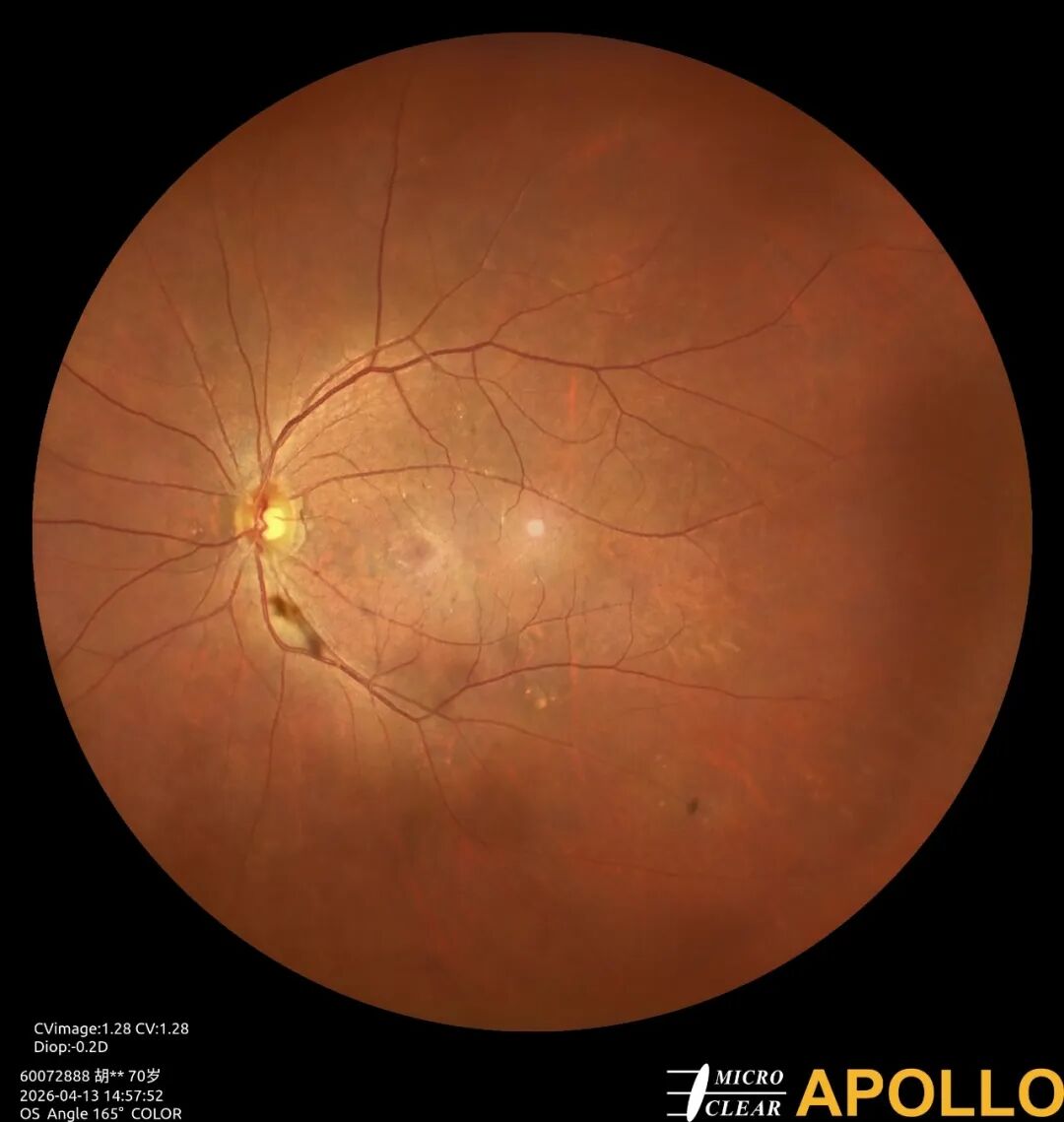 彩色眼底照相查什么眼底“侦察兵”上线！平湖一院眼科新增广角眼底激光相机_https://www.jmylbn.com_新闻资讯_第6张