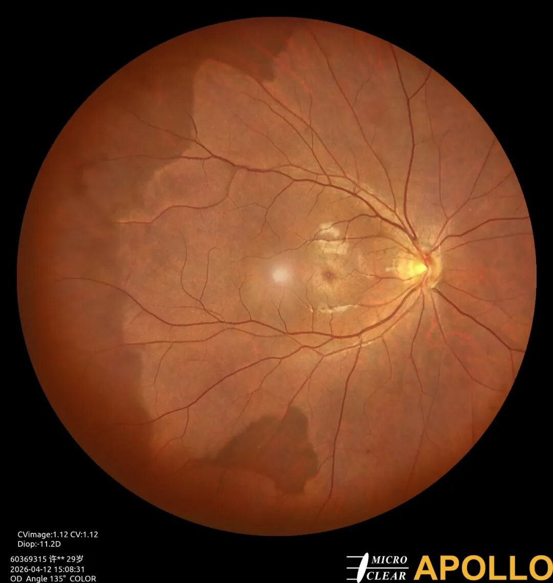 彩色眼底照相查什么眼底“侦察兵”上线！平湖一院眼科新增广角眼底激光相机_https://www.jmylbn.com_新闻资讯_第18张