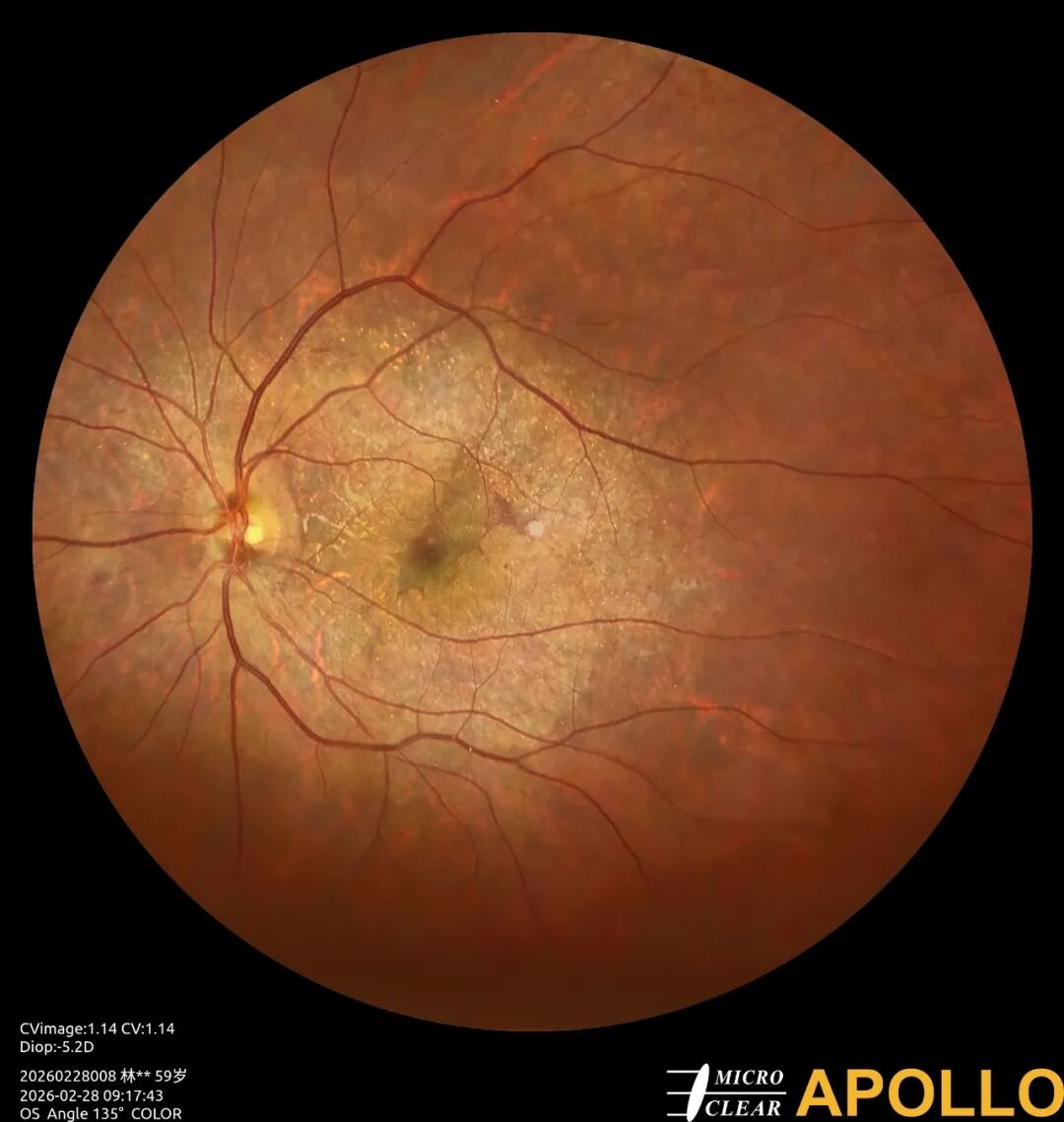 彩色眼底照相查什么眼底“侦察兵”上线！平湖一院眼科新增广角眼底激光相机_https://www.jmylbn.com_新闻资讯_第14张