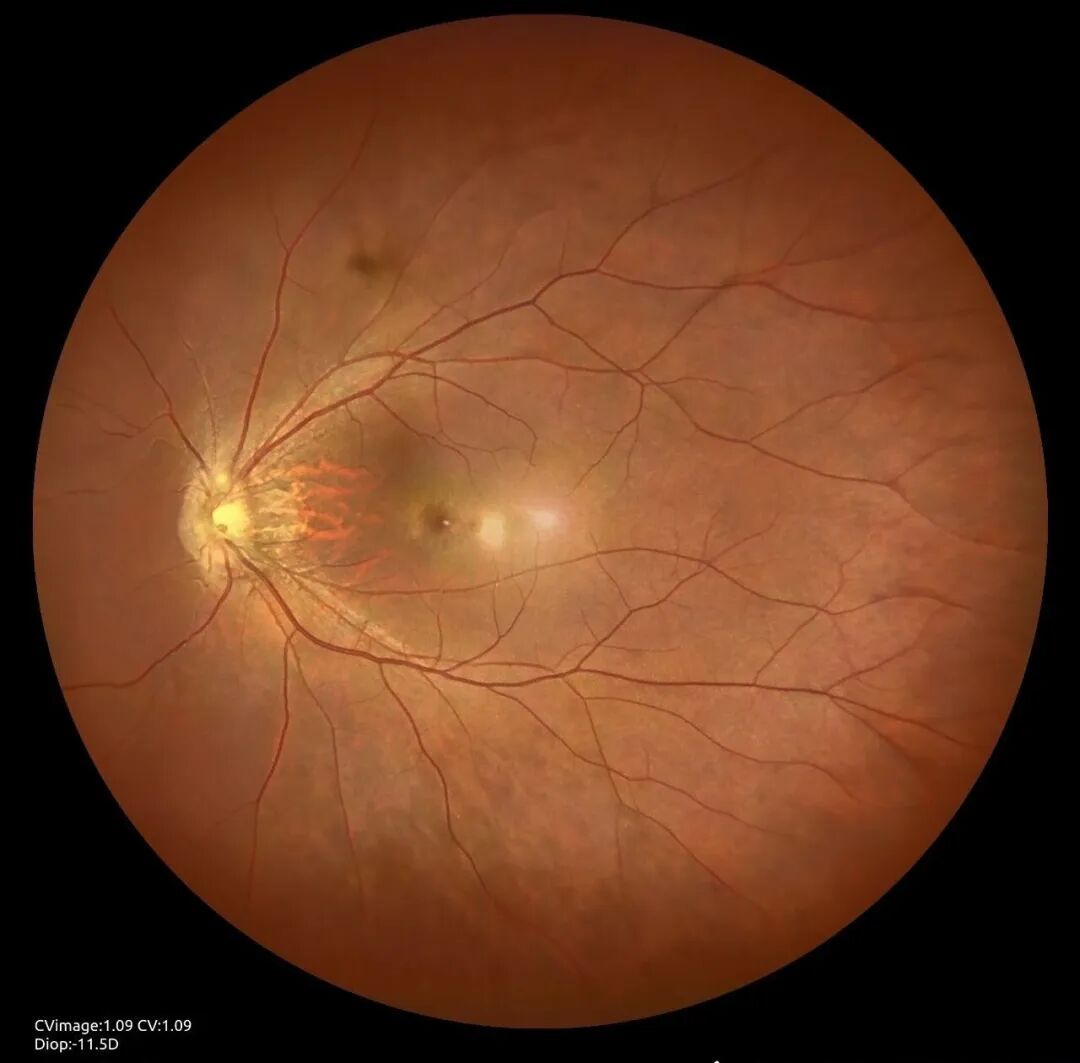 彩色眼底照相查什么眼底“侦察兵”上线！平湖一院眼科新增广角眼底激光相机_https://www.jmylbn.com_新闻资讯_第4张