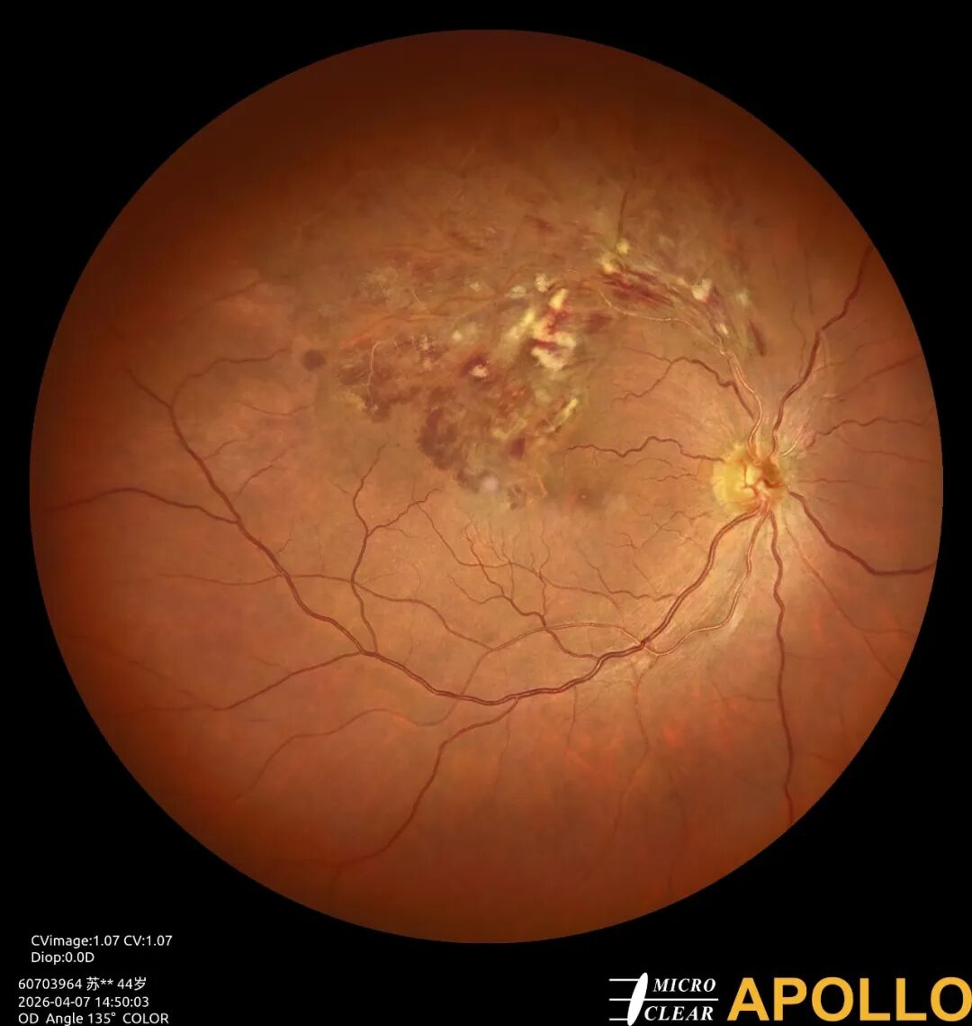 彩色眼底照相查什么眼底“侦察兵”上线！平湖一院眼科新增广角眼底激光相机_https://www.jmylbn.com_新闻资讯_第11张