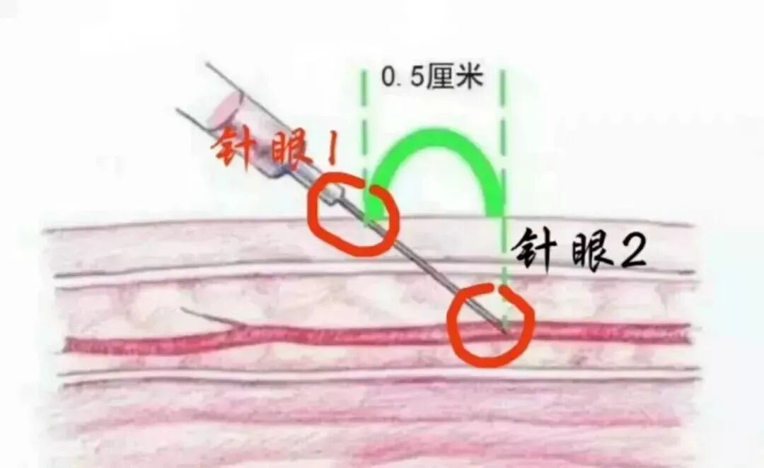 动脉留置针怎么输液儿科输液纠纷多，这么回答保平安！_https://www.jmylbn.com_新闻资讯_第4张