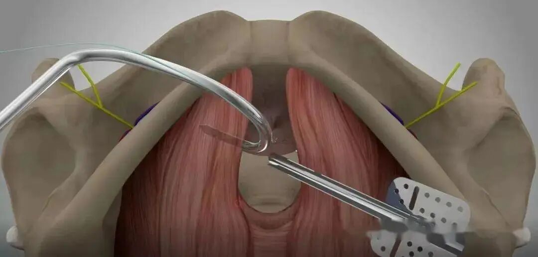 尿道张力过强怎么办【技术拓展】广南县中医医院妇产科开展经闭孔无张力尿道悬吊术（TVT-O），助尿失禁患者摆脱疾病困扰！_https://www.jmylbn.com_新闻资讯_第6张